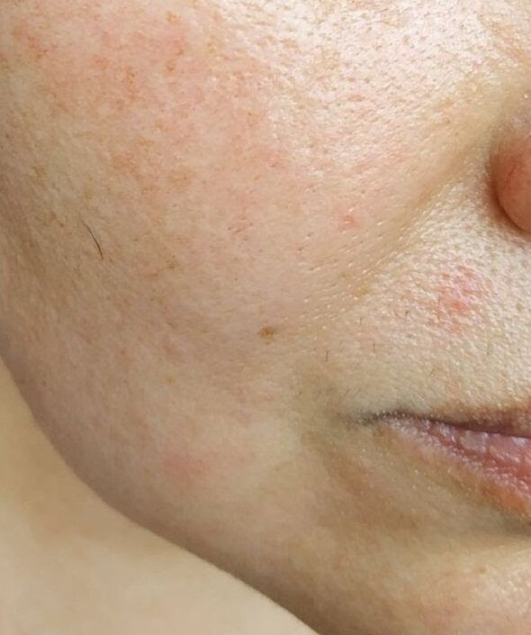 Intenskin librouse de profundos pliegues nasolabiais